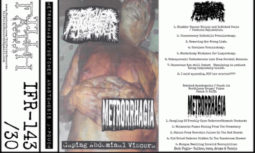 Botched Anastomosis J-Pouch : Botched Anastomosis J-Pouch - Metrorrhagia